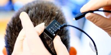Εκπληκτικό εμφύτευμα εγκεφάλου δίνει φωνή σε άτομα που δεν μπορούσαν να μιλήσουν για χρόνια